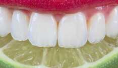 Como Evitar a Erosão Dental