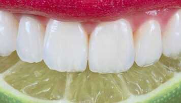 Como Evitar a Erosão Dental